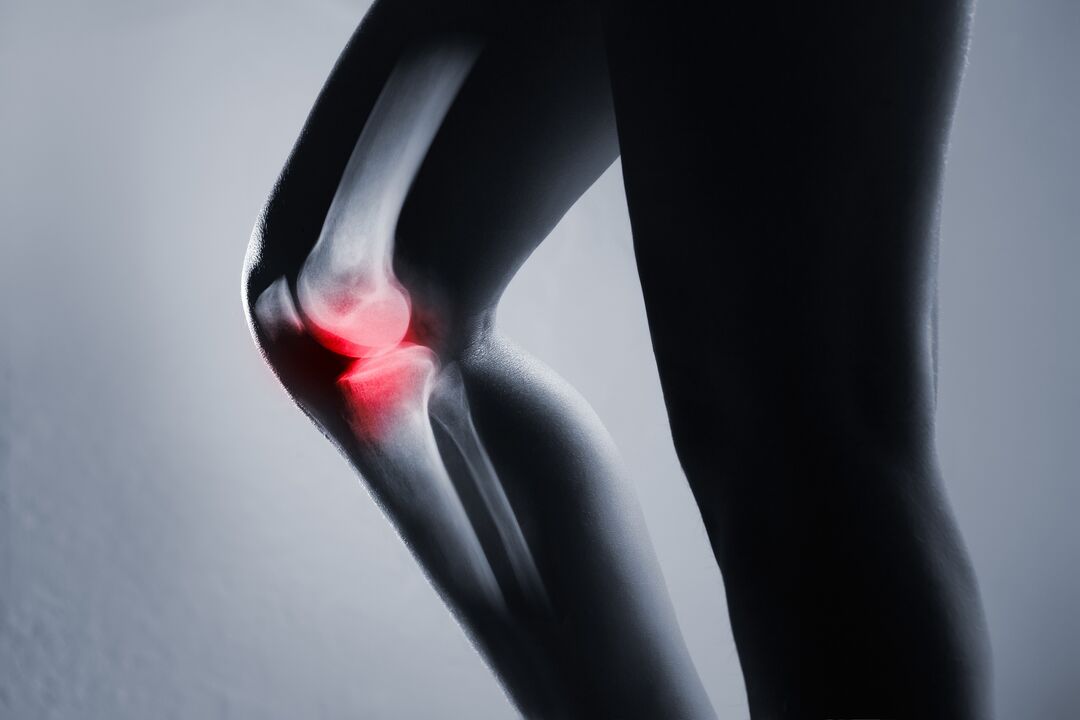 Kniegelenkentzündung mit Arthrose