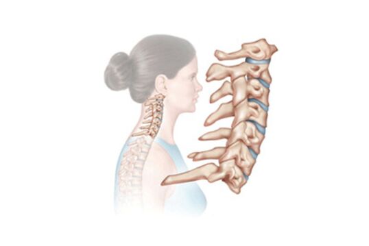 Schädigung der Halswirbelsäule mit Osteochondrose