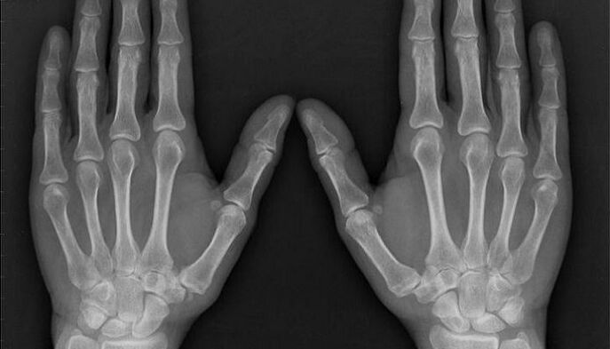 Röntgen zur Diagnose von Arthritis und Arthrose