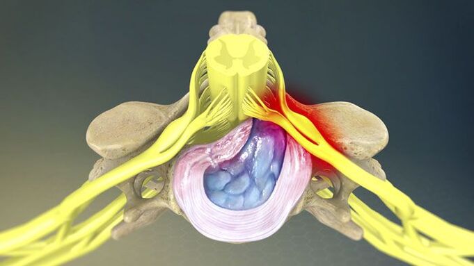 Eine der Ursachen für Rückenschmerzen ist ein Bandscheibenvorfall. 
