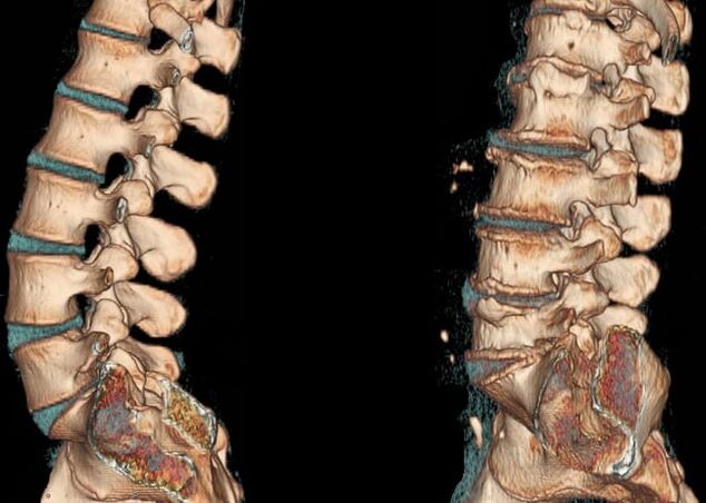 Osteochondrose der Lumbalregion