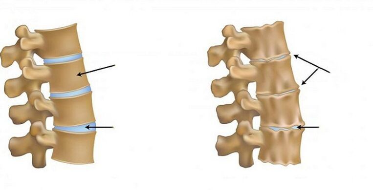 ischämisches Syndrom für Osteochondrose