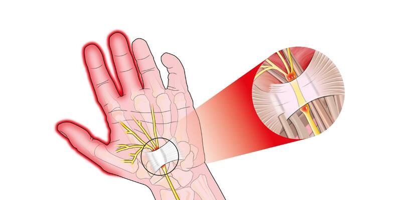 Schmerzen in den Fingern der Finger mit Risartrose