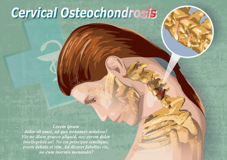 zervikale Osteochondrose ist eine Krankheit des Knorpelgewebes